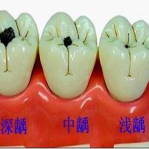 蛀牙修复几种方式了解清楚 就能知道蛀牙怎么办了